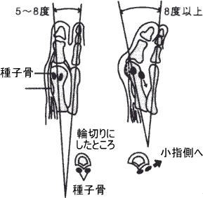 外反母趾の状態
