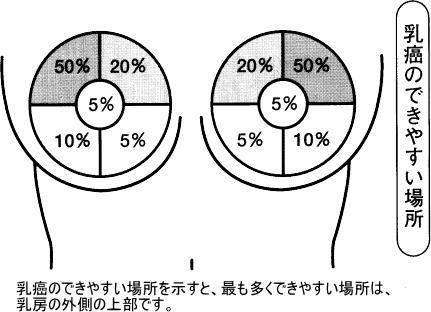 乳がんのできやすい場所