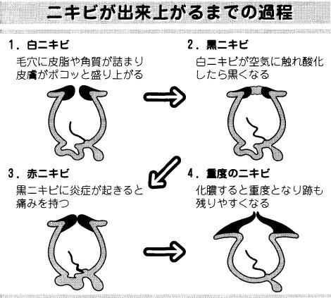 ニキピ