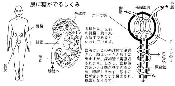 尿に糖がでるしくみ図
